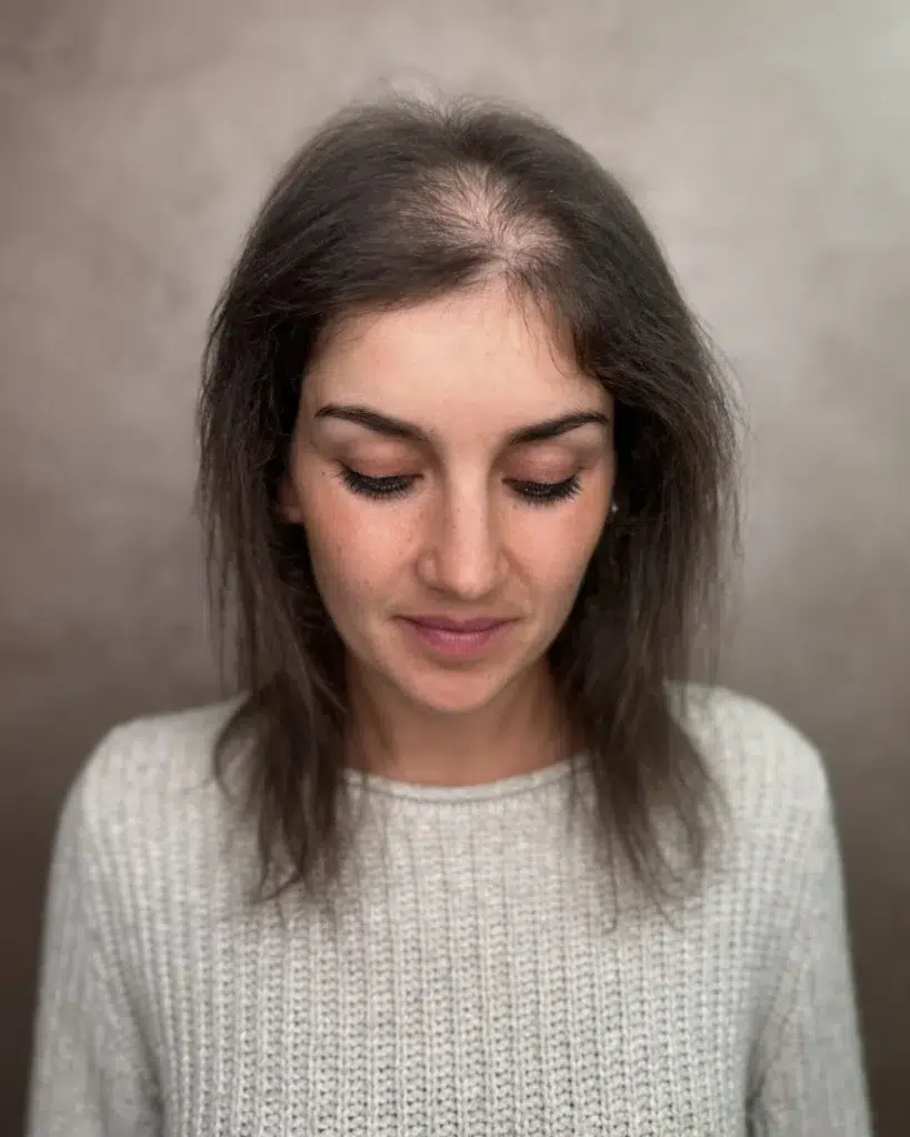 Franzi vorher – Hairdreams MicroLines Haarverdichtung